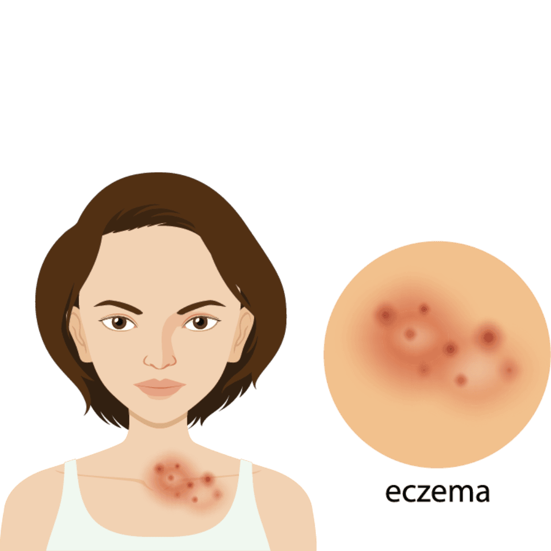 PCOS Treatment