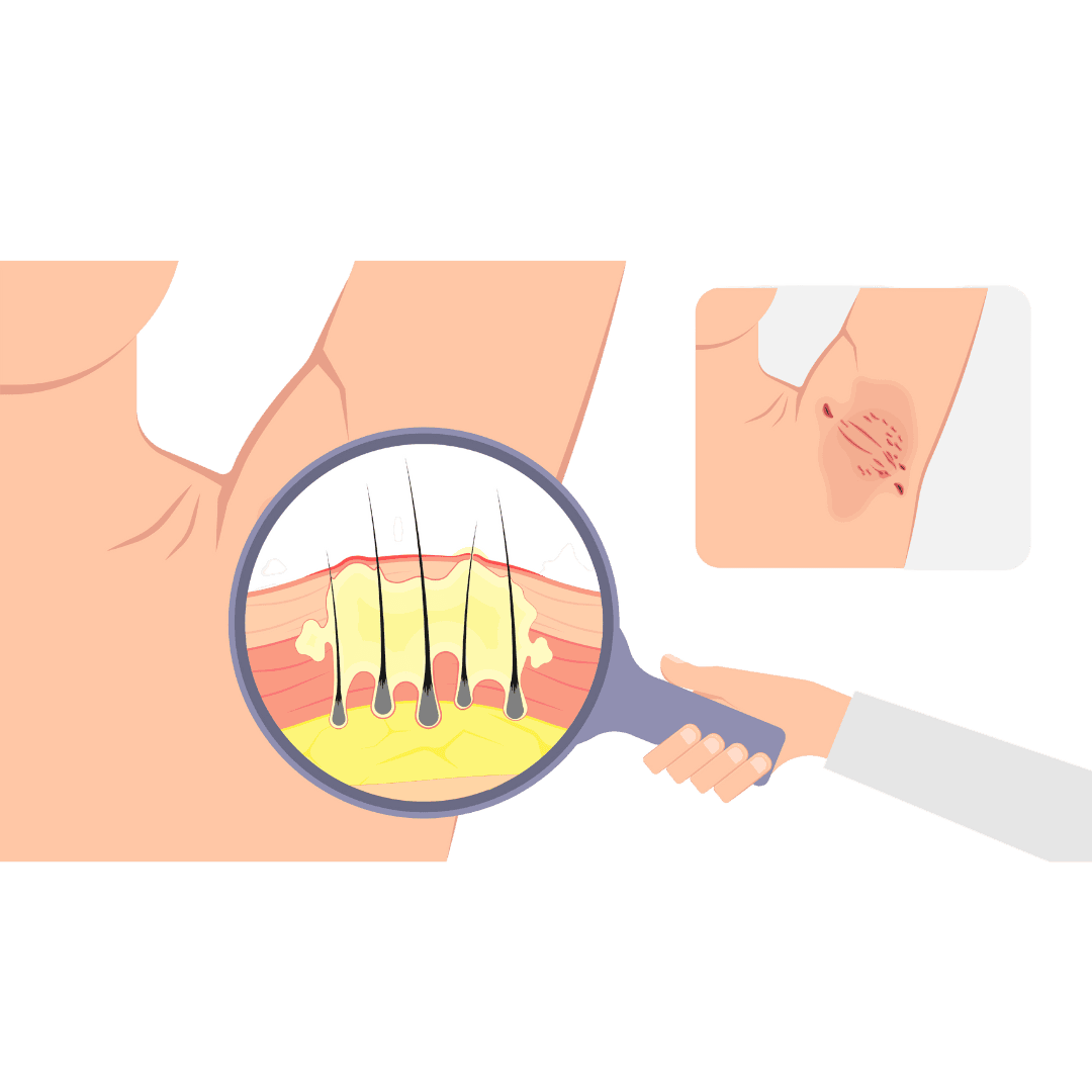 PCOS Treatment