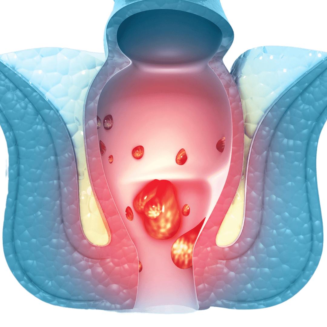 PCOS Treatment