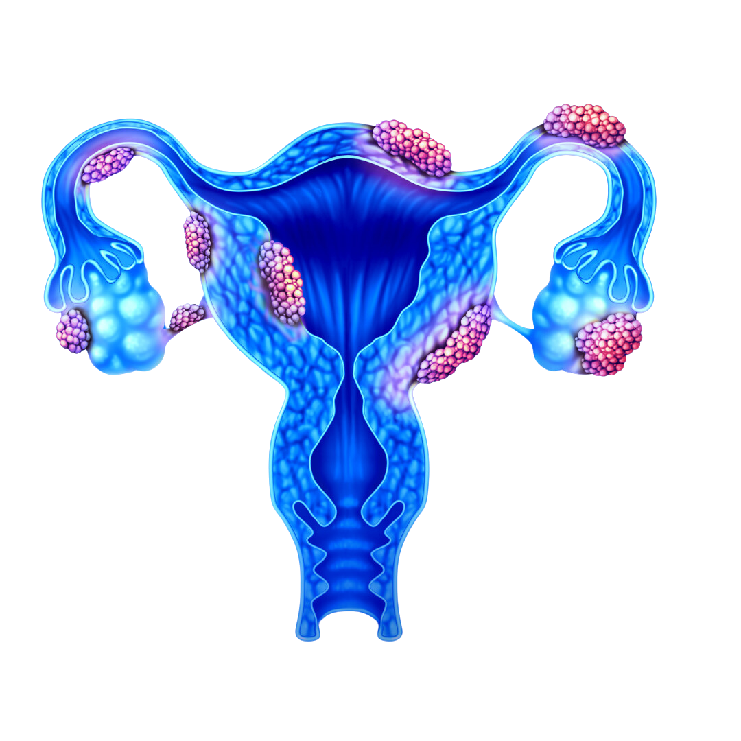 PCOS Treatment