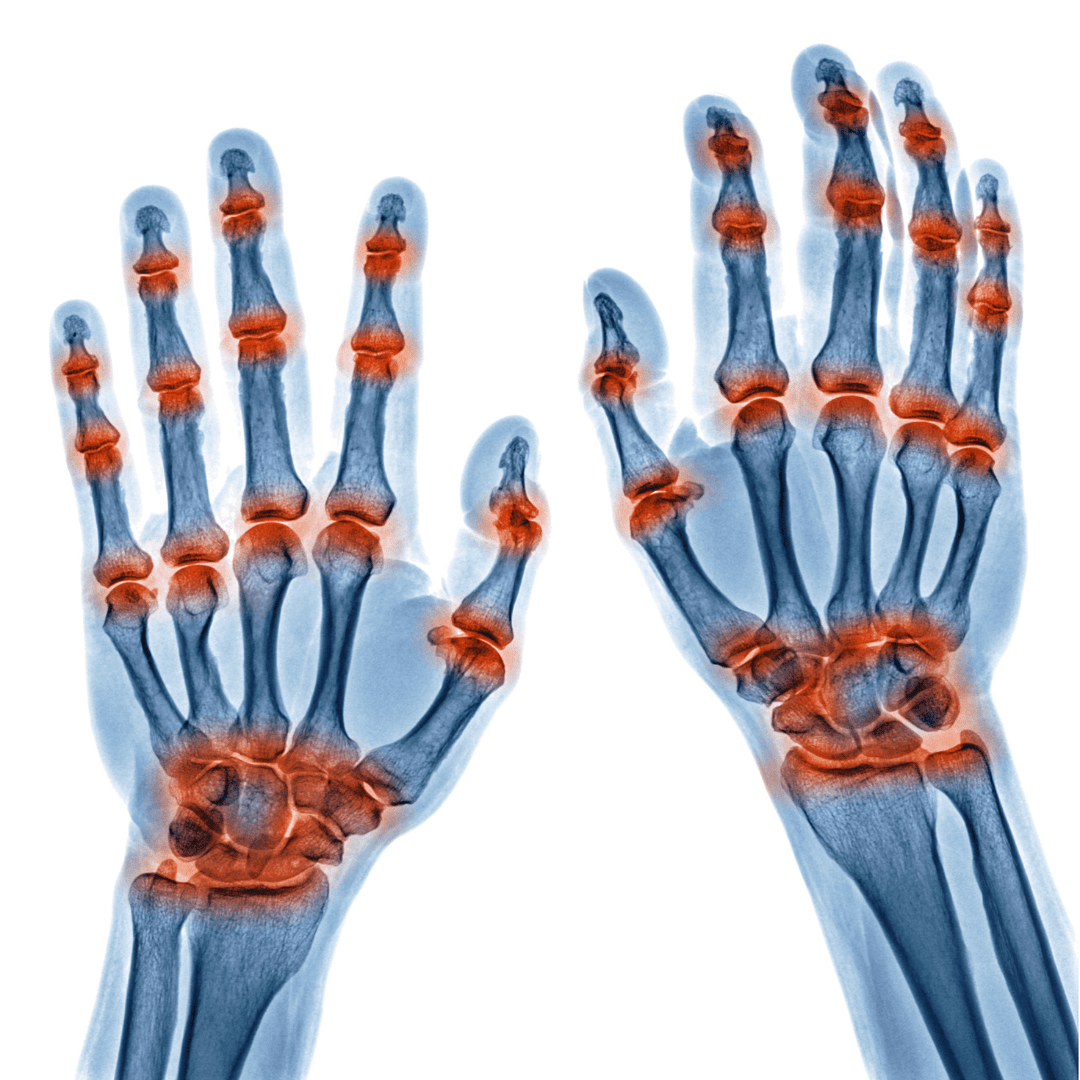 Rheumatoid Arthritis Treatment