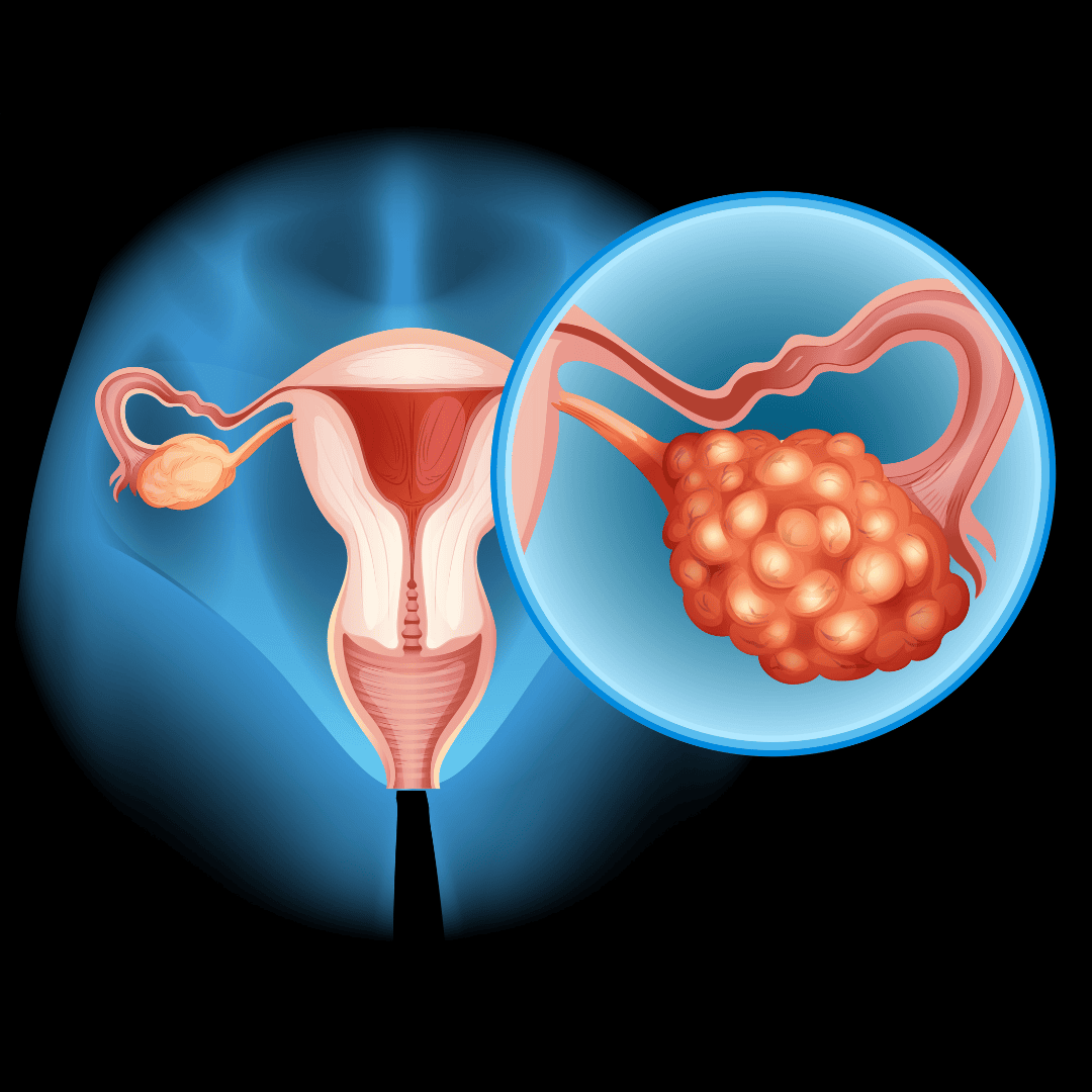 PCOS Treatment
